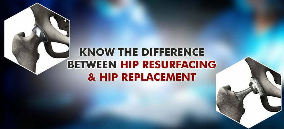 hip resurfacing and hip replacement