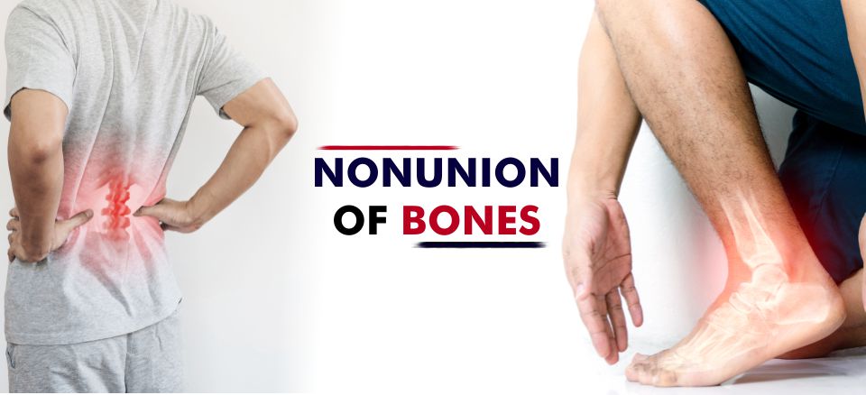 Nonunion of bones