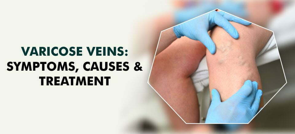 Varicose Veins - Symptoms, Causes & Treatment