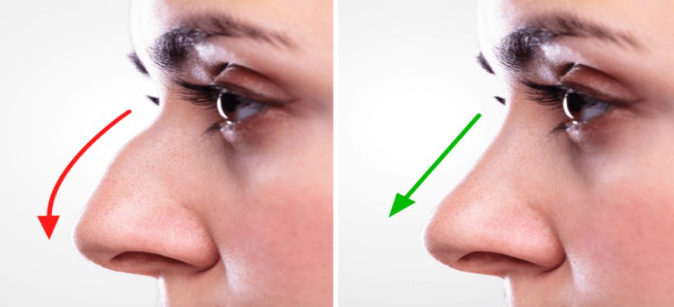 Rhinoplasty