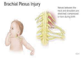 newborn child brachial plexus