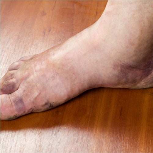 swelling on foot