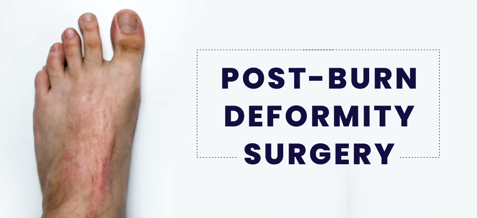 Post-burn deformity