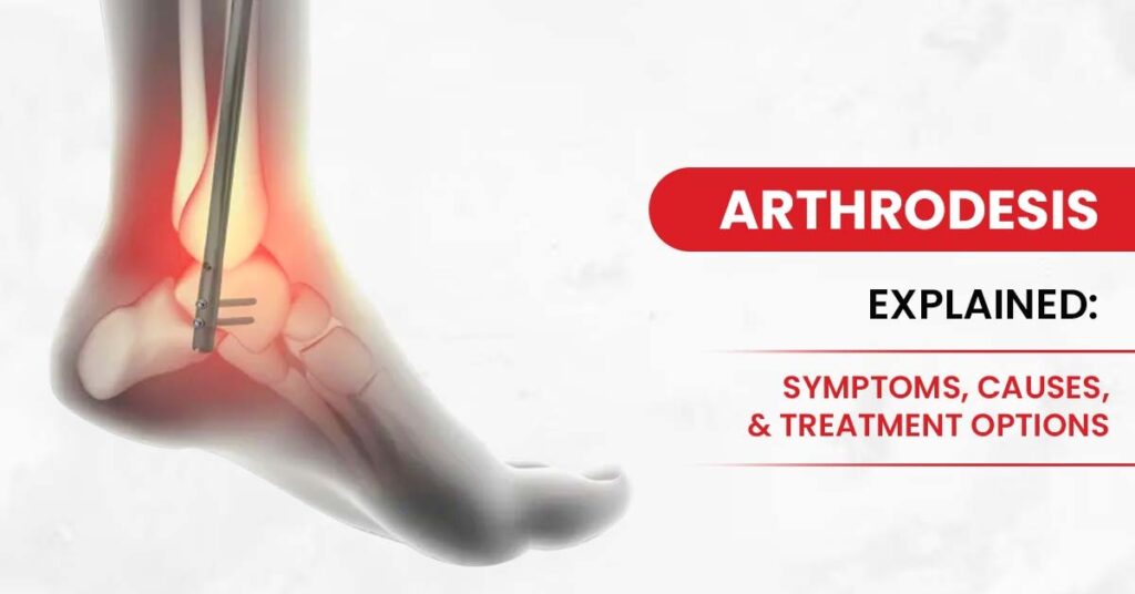 Arthrodesis Explained : Symptoms & Treatments - amandeephospital