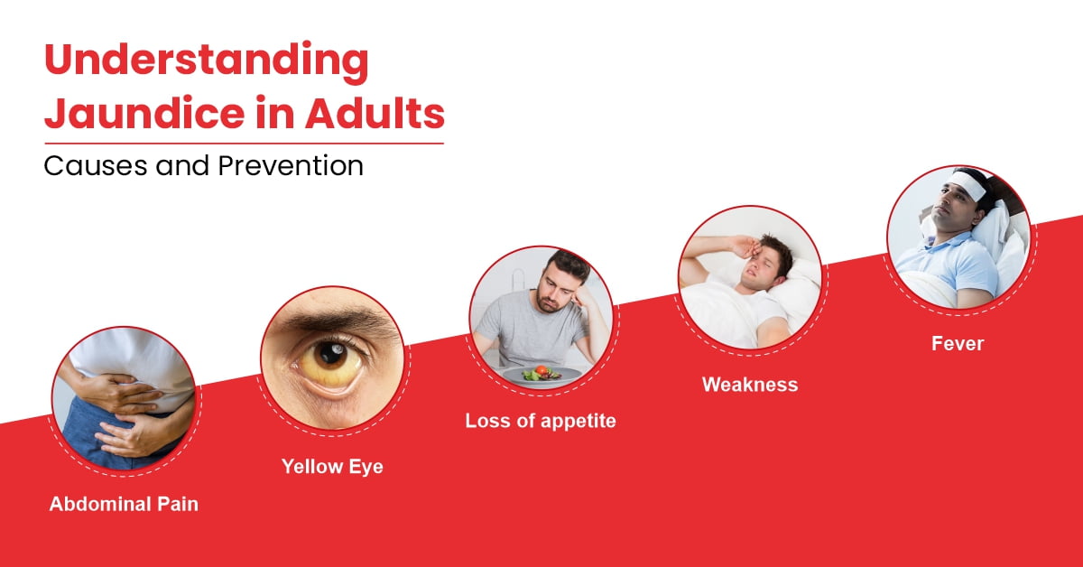 Jaundice in Adults