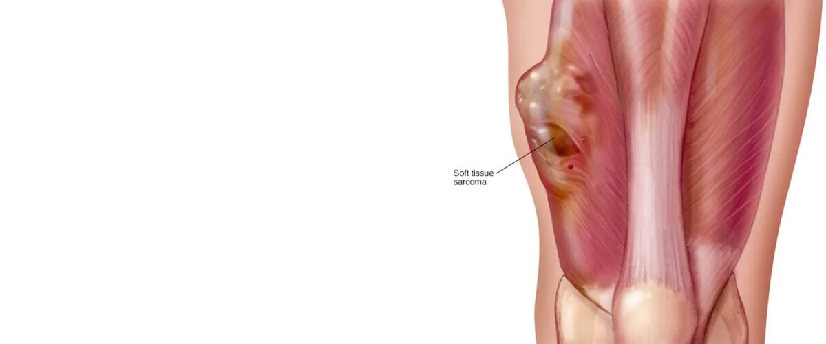 Soft Tissue Sarcoma