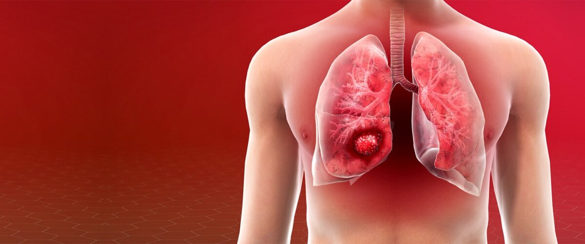 Mediastinal and Lung Cancer