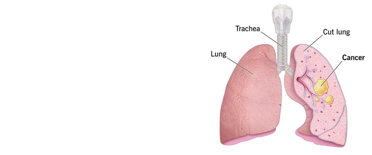 Lung Cancer