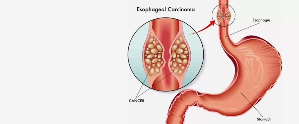 Esophageal Cancer