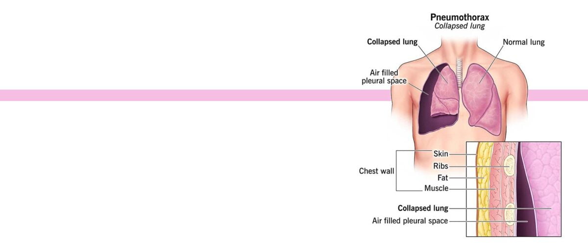 Pneumothorax