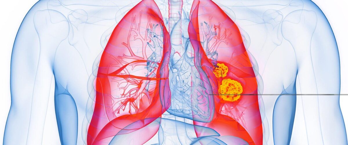 Lung Cysts