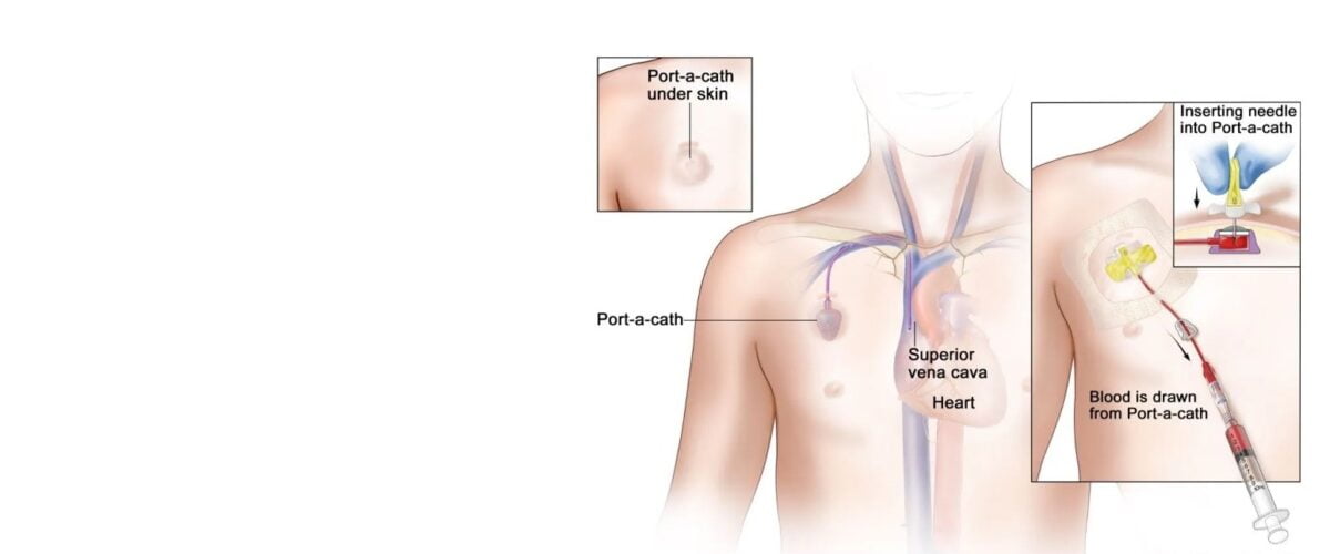 Chemoport, PERM cath & PICC Line