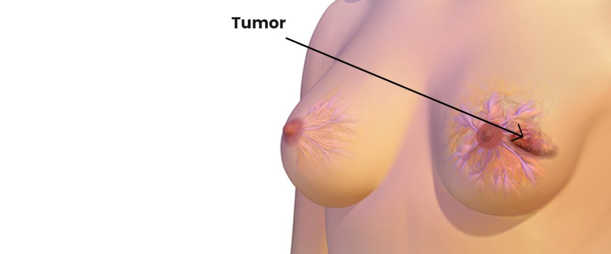 Breast Tumor